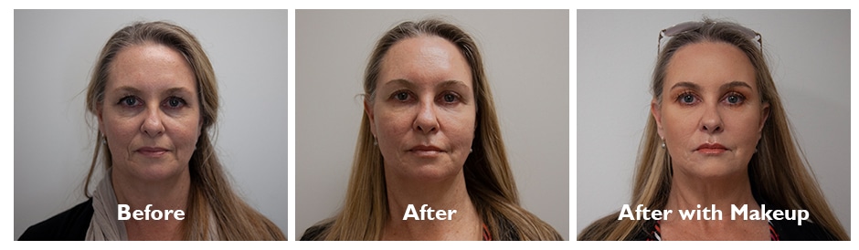 Before And After Non-Surgical Make-Over
