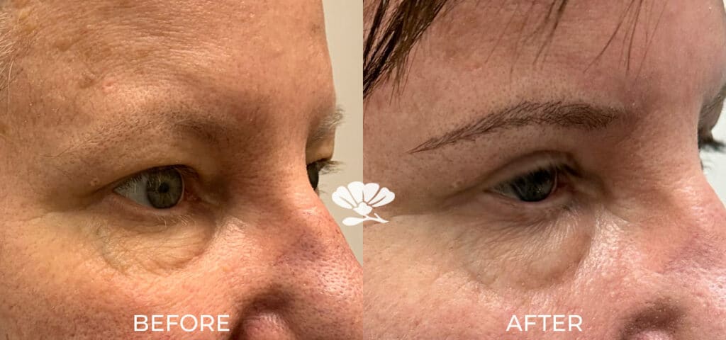 Before And After Blepharoplasty Upper Eyelid Surgery Perth Cosmetic Surgeon