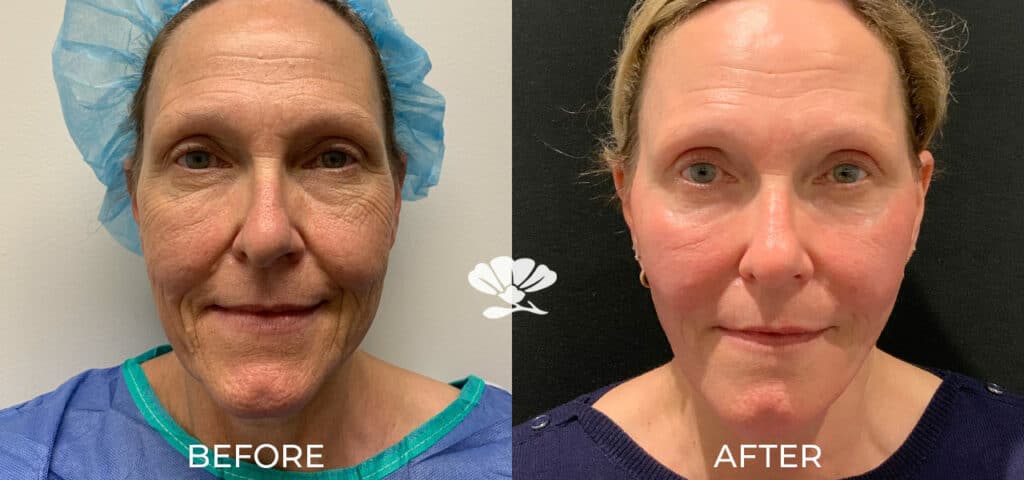 Mini Facelift Perth Before And After Photo Plastic Cosmetic Surgery