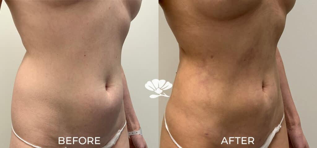 Liposuction Perth Before And After Photo Stomach Abdomen